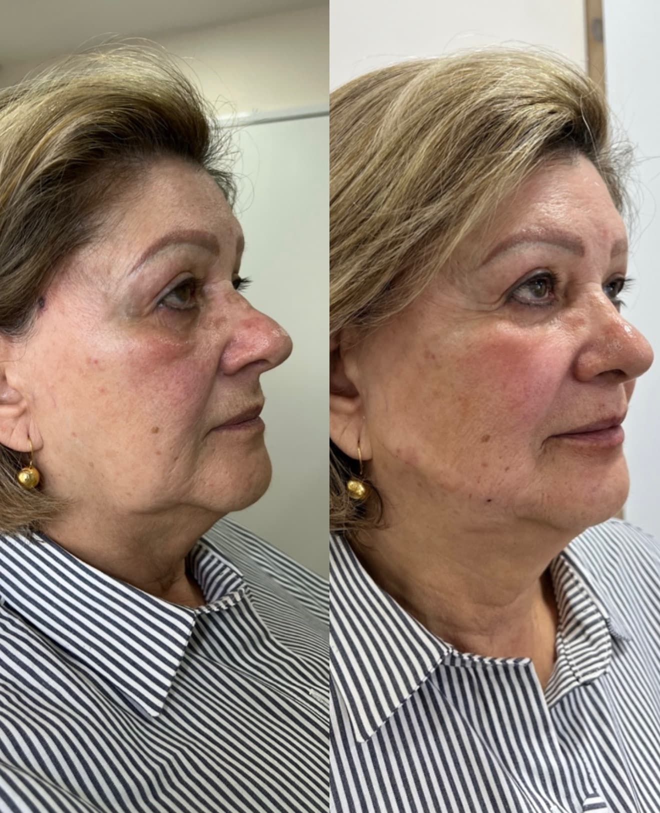 Antes e depois — Preenchimento de olheiras + bioestimulador de colágeno