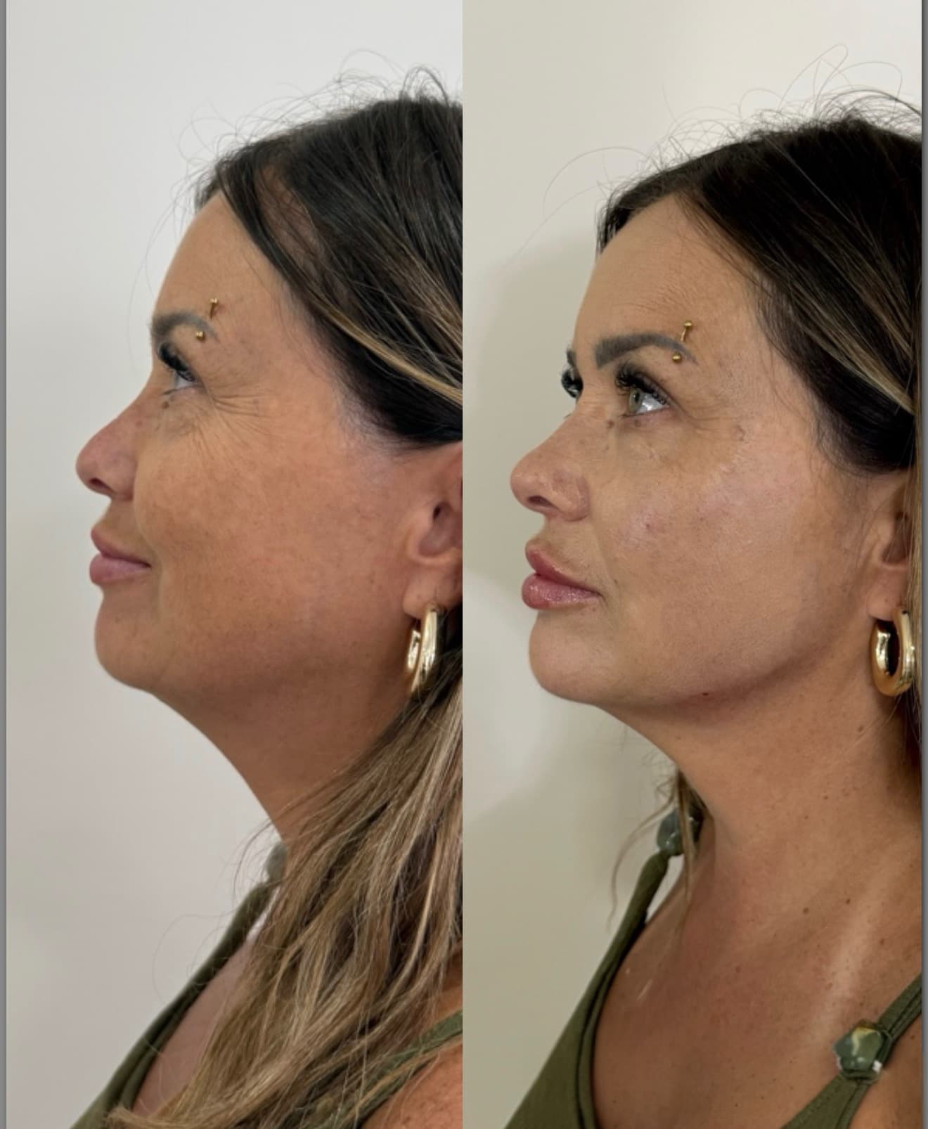 Antes e depois — Preenchimento labial + suavização do sulco nasogeniano