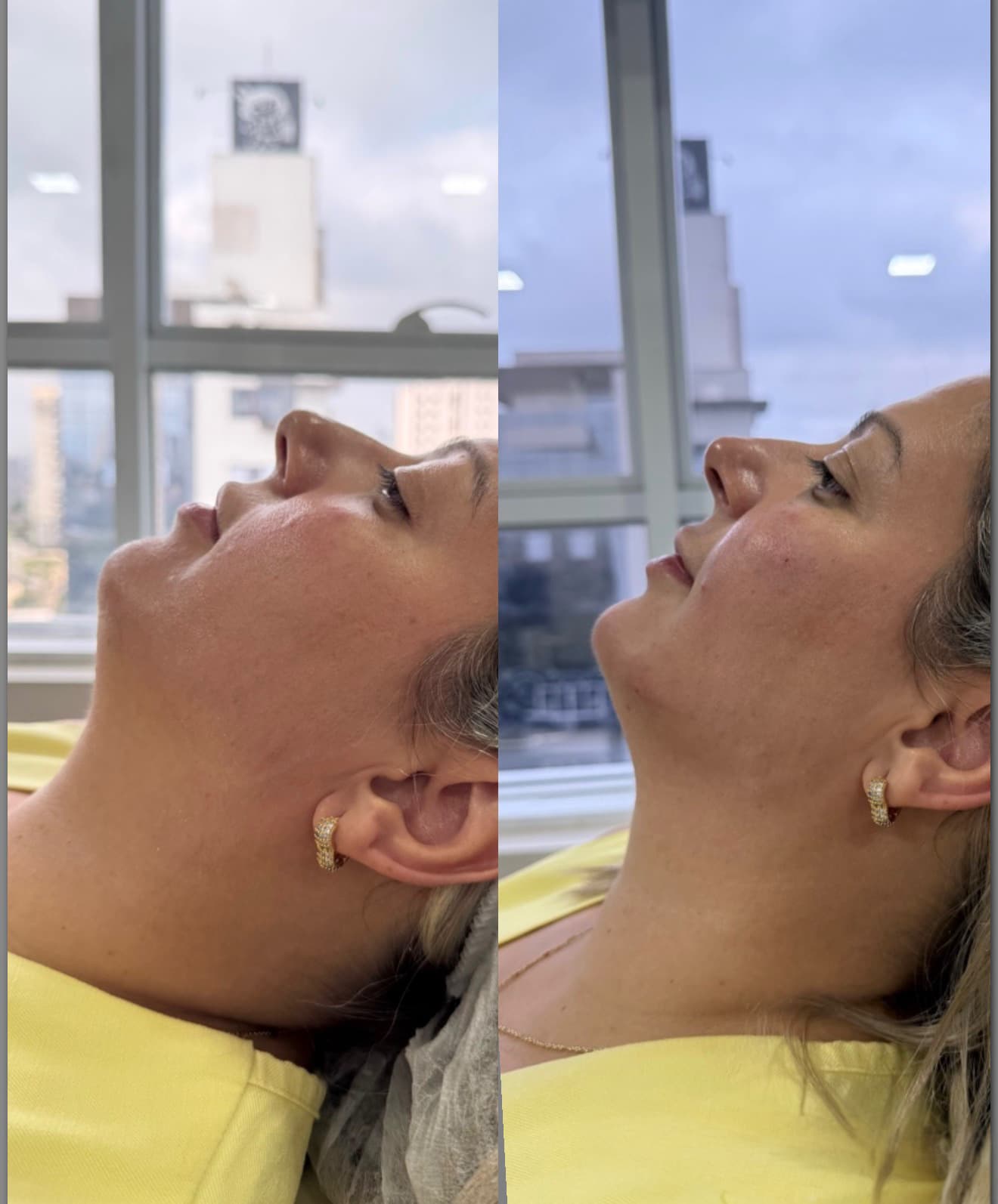 Antes e depois — Emagrecimento facial + lipo de papada