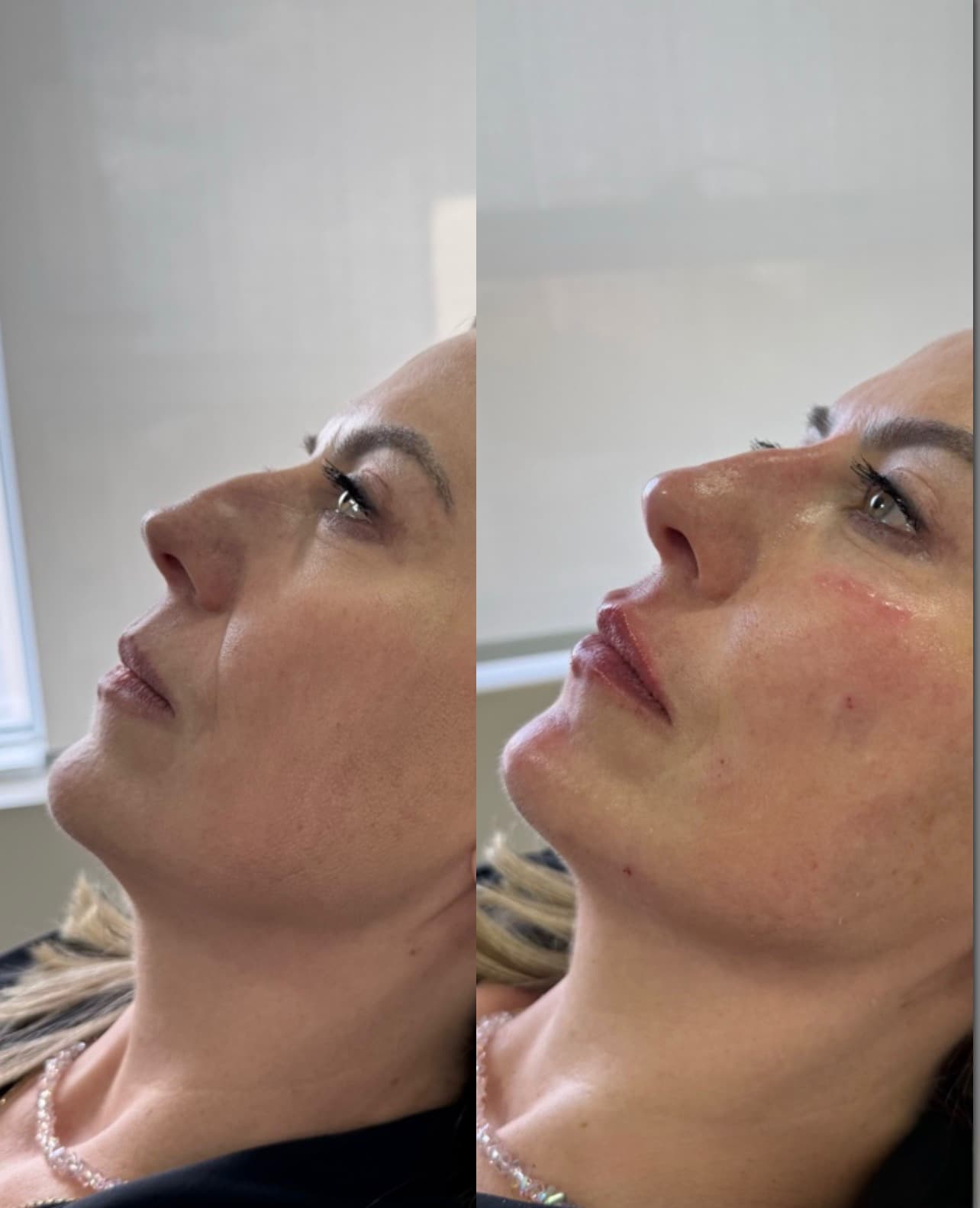 Antes e depois — Preenchimento labial + bioestimulador facial
