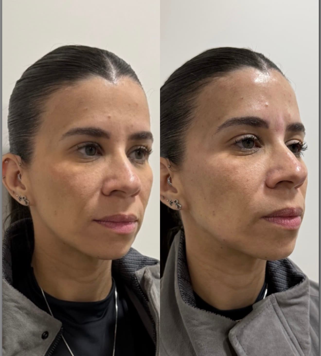 Antes e depois — Bioestimulador de colágeno + harmonização full face