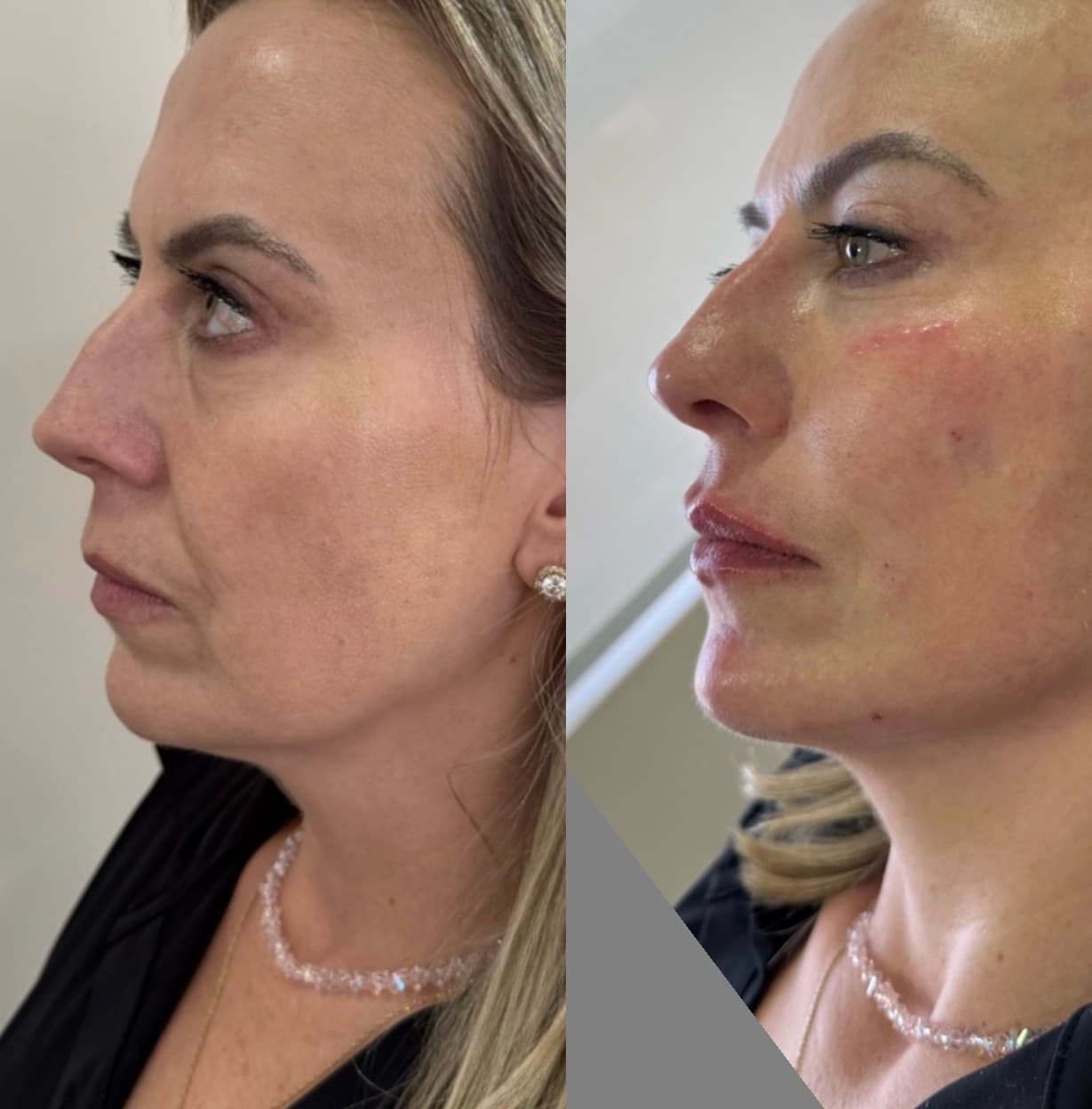 Antes e depois — Bioestimulador + preenchimento de olheiras