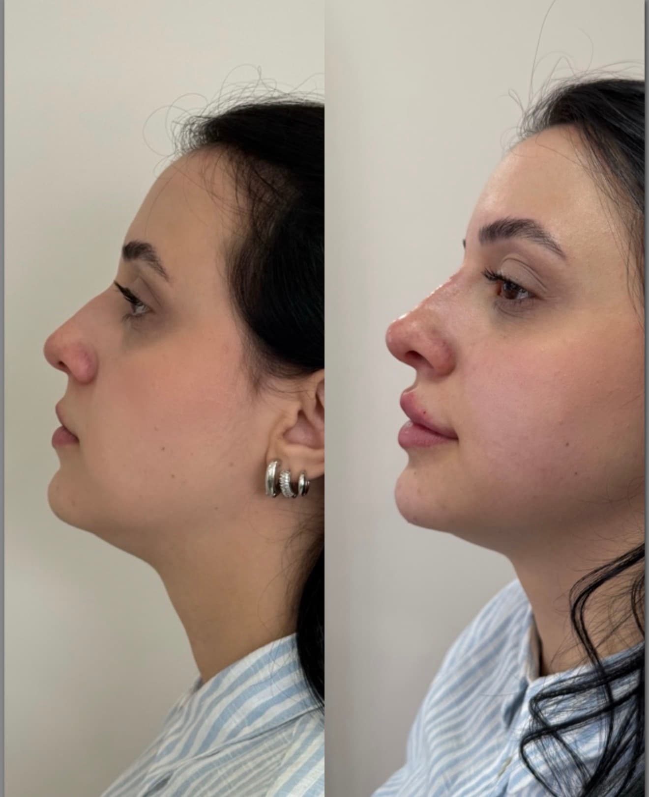 Antes e depois — Rinomodelação não cirúrgica
