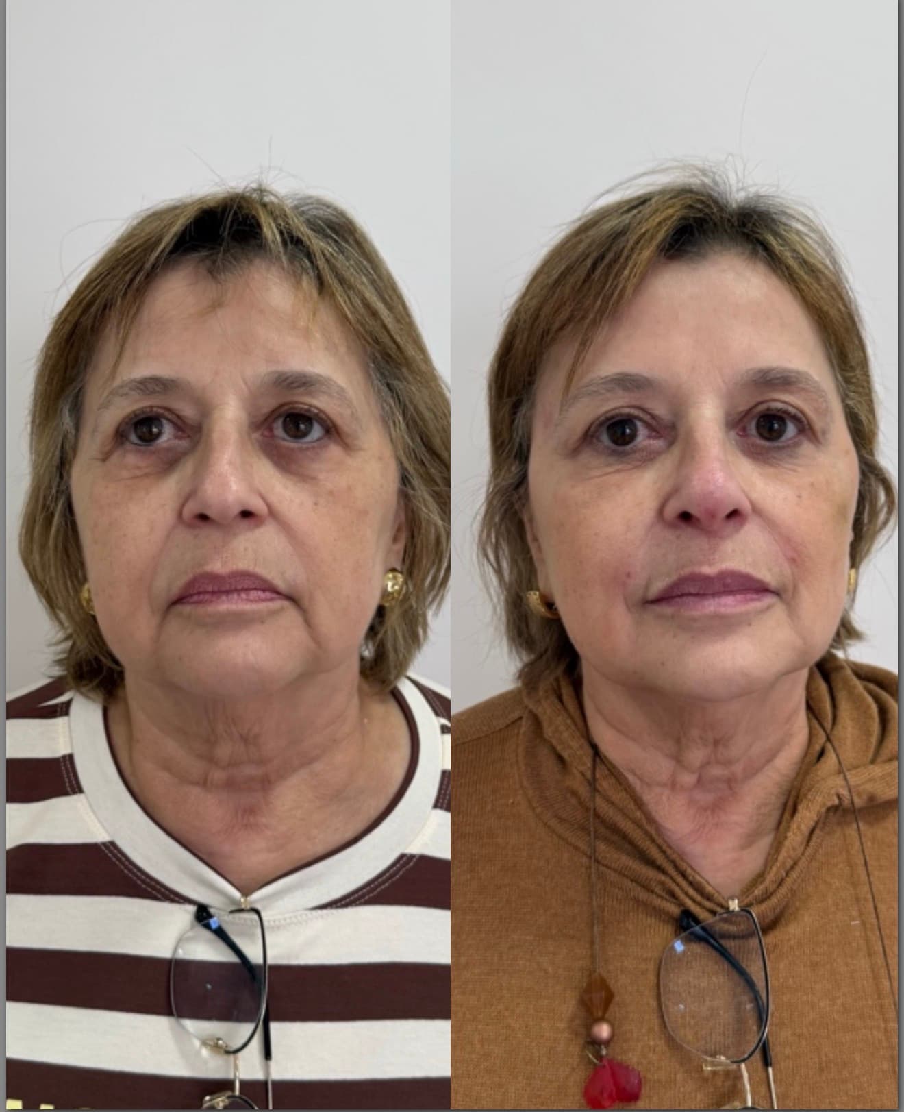 Antes e depois — Bioestimulador + fios de PDO + toxina botulínica