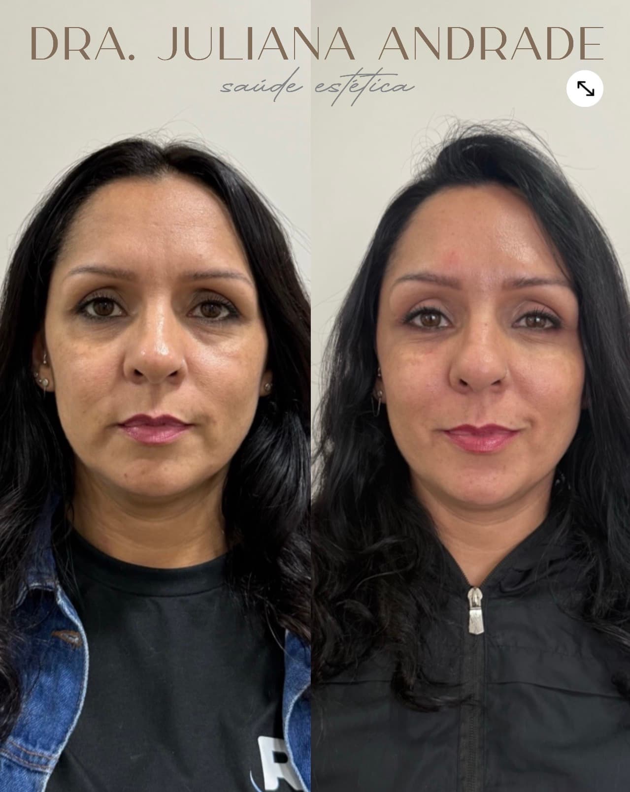 Antes e depois — Toxina botulínica + preenchimento de olheiras