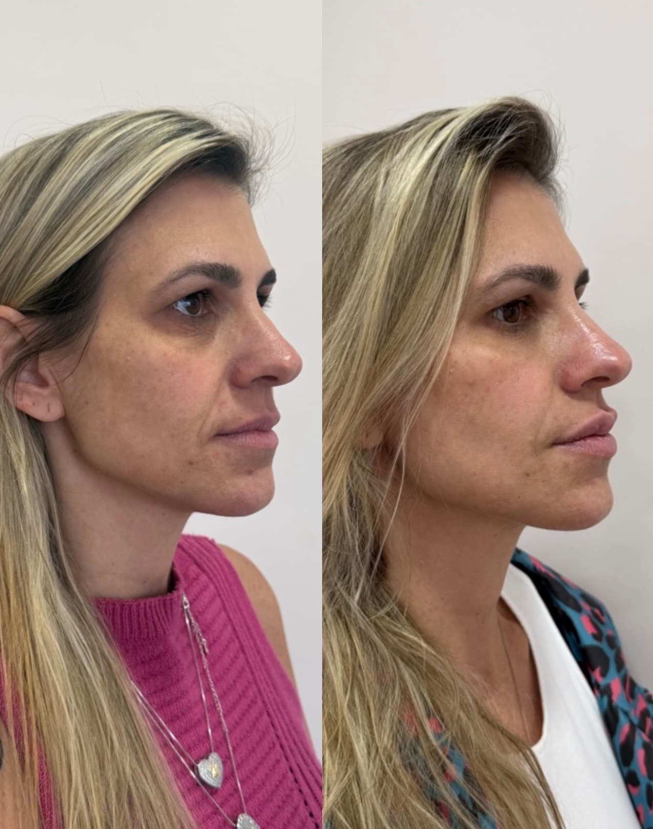 Antes e depois — Bioestimulador + preenchimento de olheiras