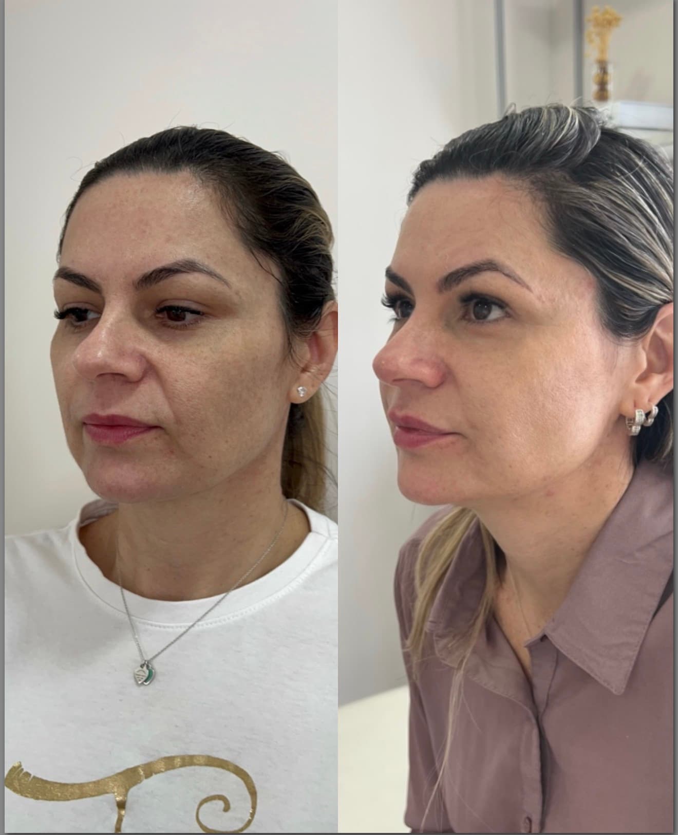 Antes e depois — Preenchimento de maçãs + toxina botulínica