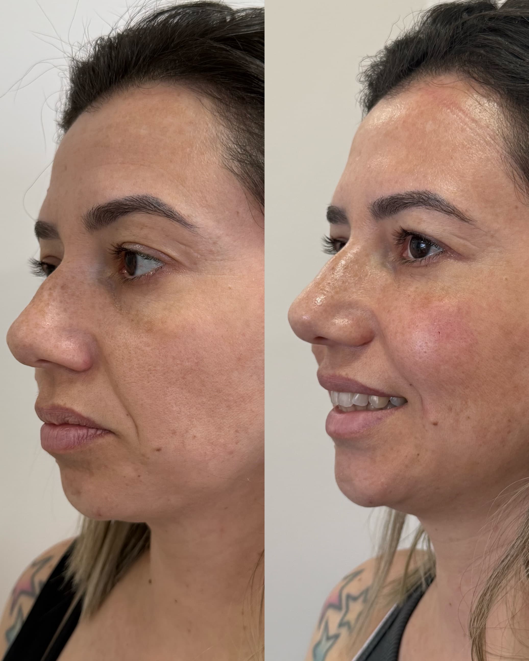 Antes e depois — Preenchimento de olheiras + PDRN