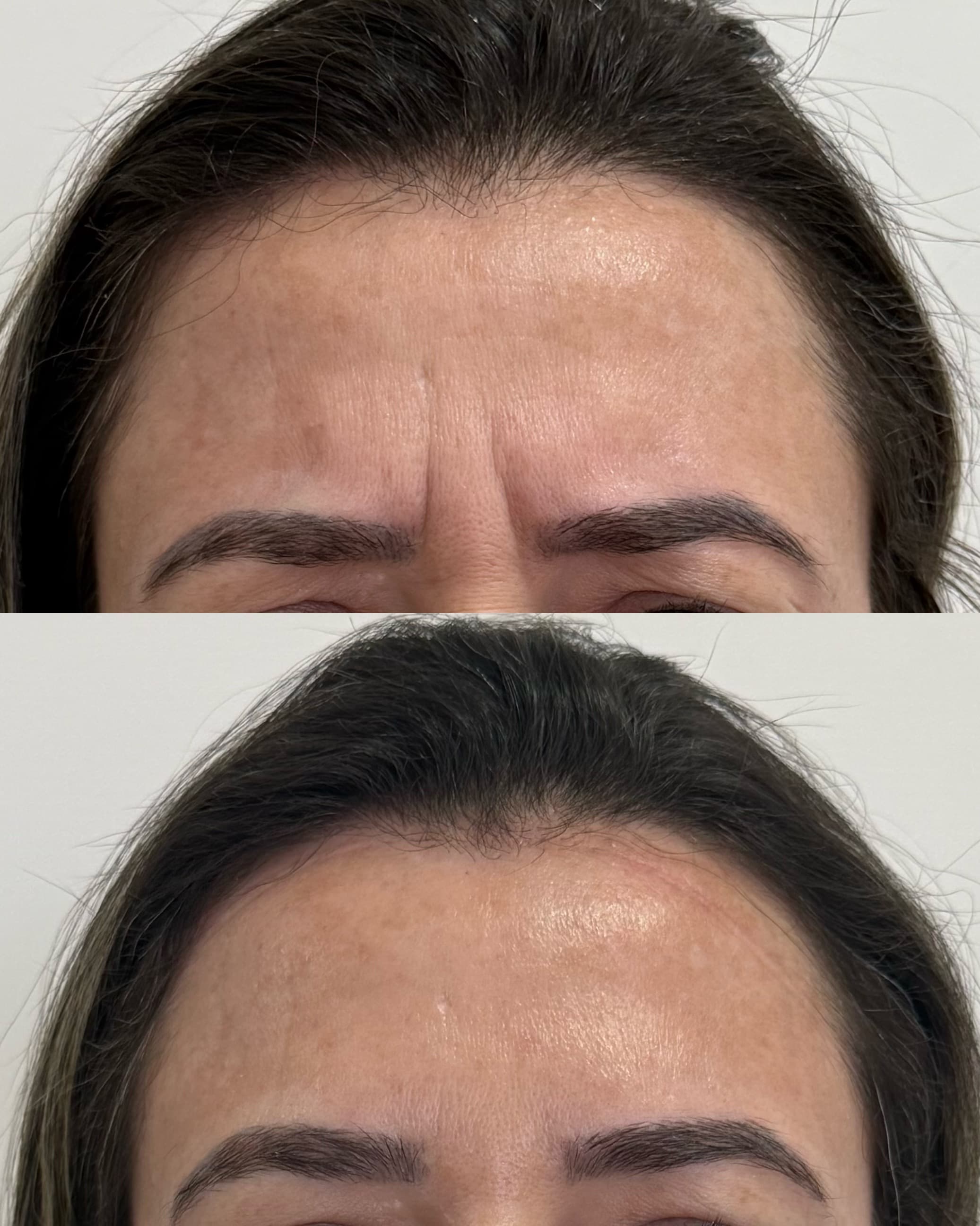 Antes e depois — Toxina botulínica — terço superior