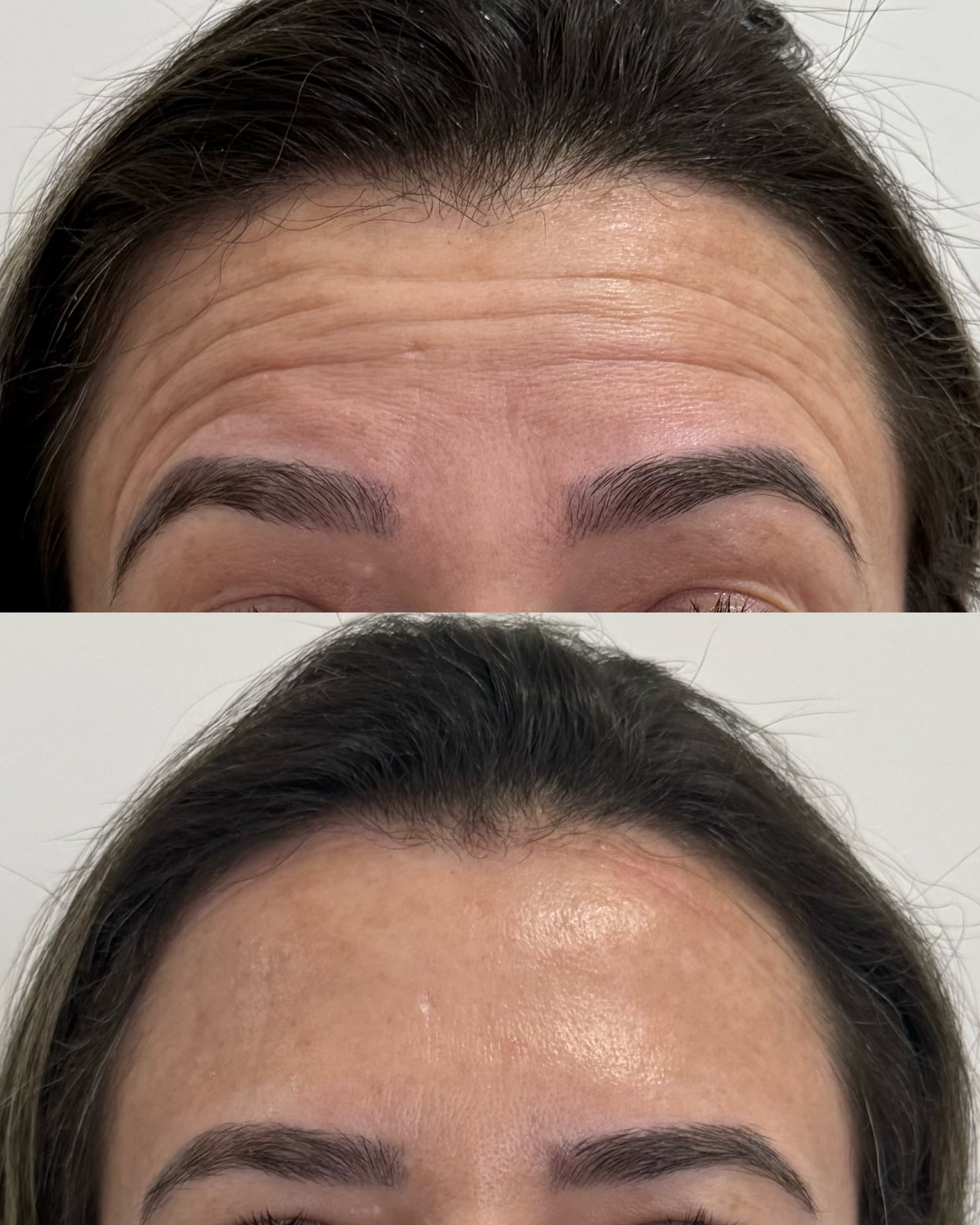 Antes e depois — Toxina botulínica — frontal
