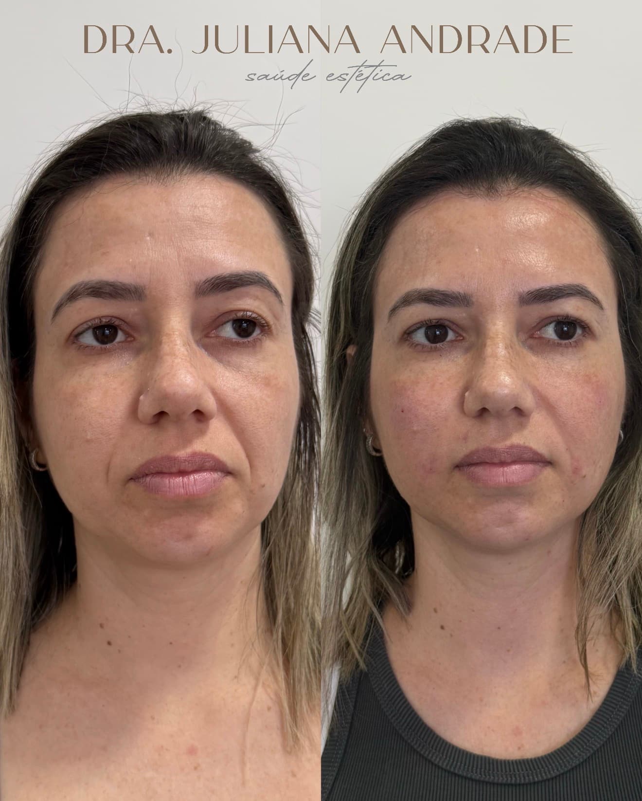Antes e depois — Bioestimulador + preenchimento de olheiras
