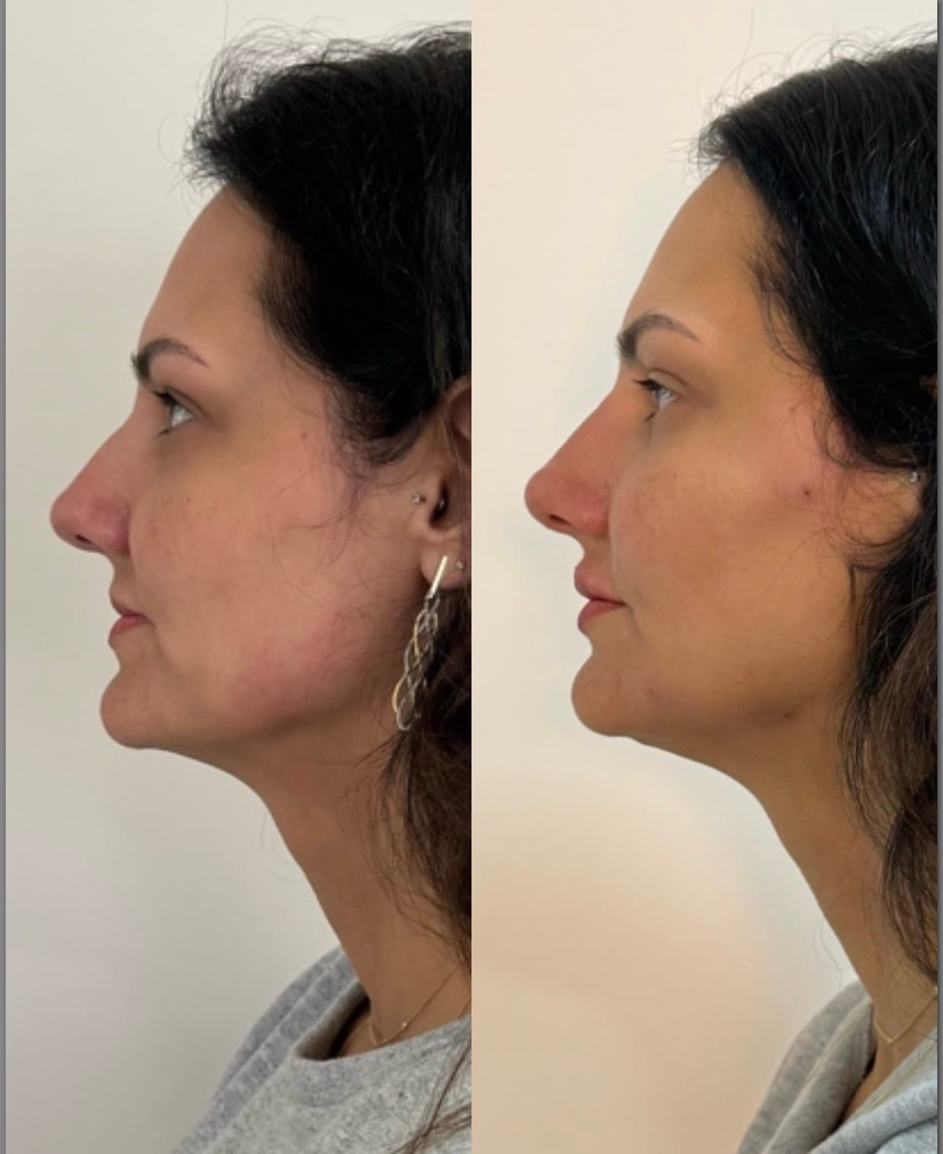 Antes e depois — Rinomodelação + preenchimento de mento