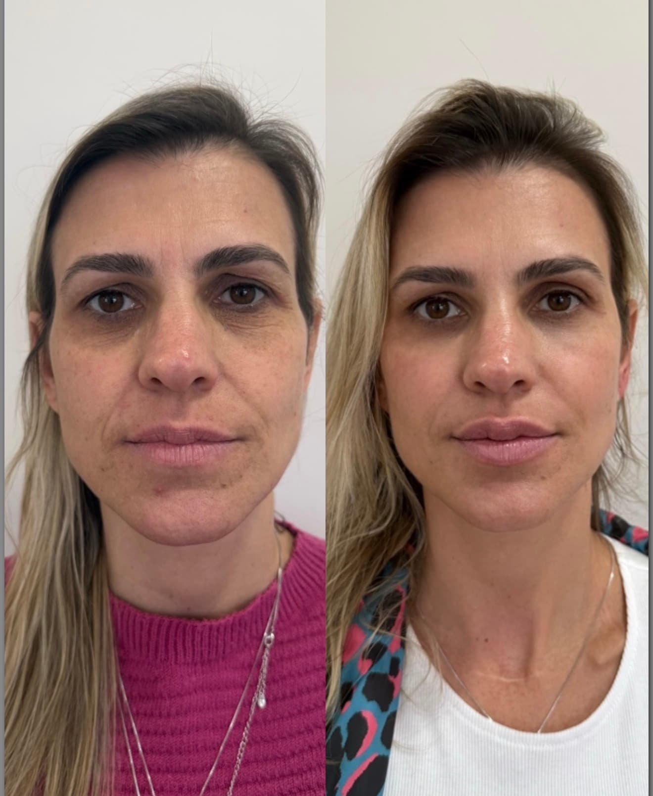 Antes e depois — Preenchimento labial + olheiras + bioestimulador