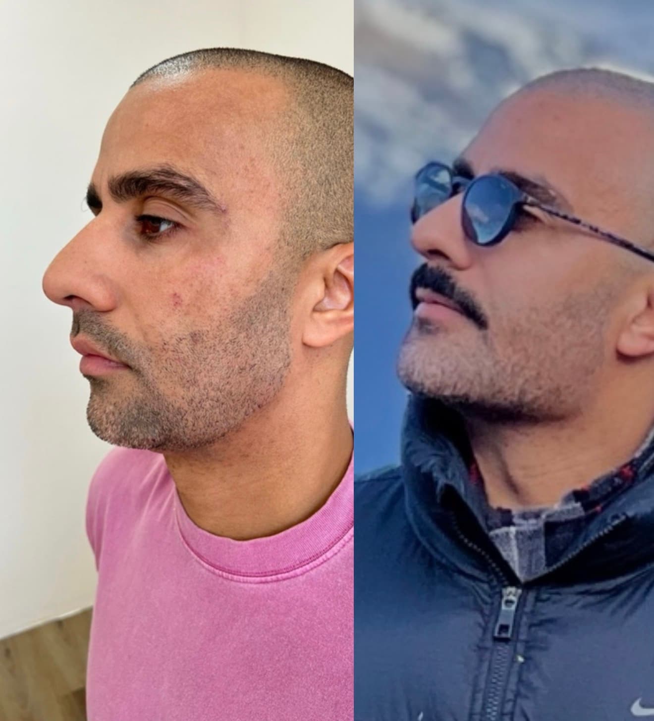 Antes e depois — Toxina botulínica + bioestimulador (masculino)