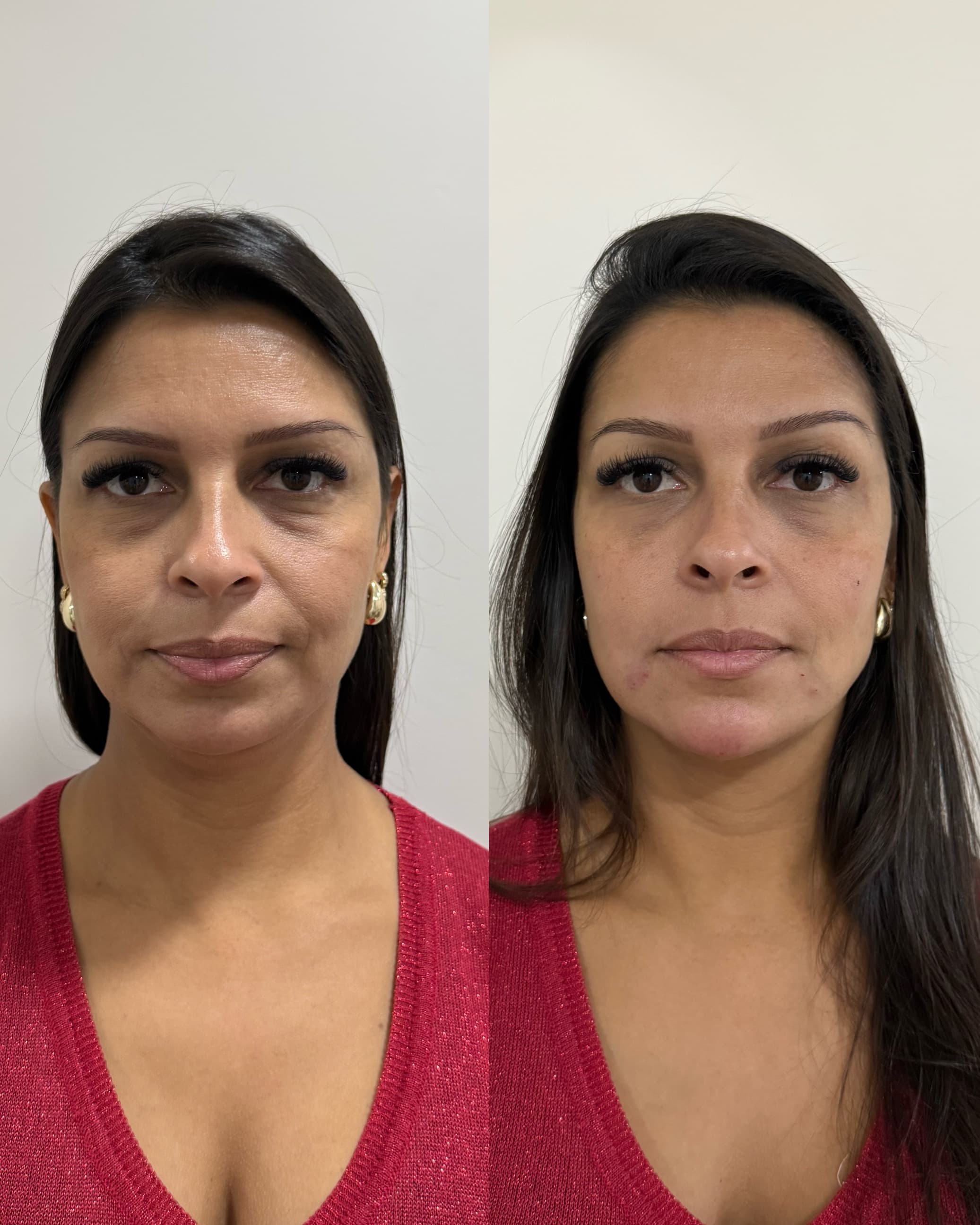 Antes e depois — Emagrecimento facial + contorno mandibular
