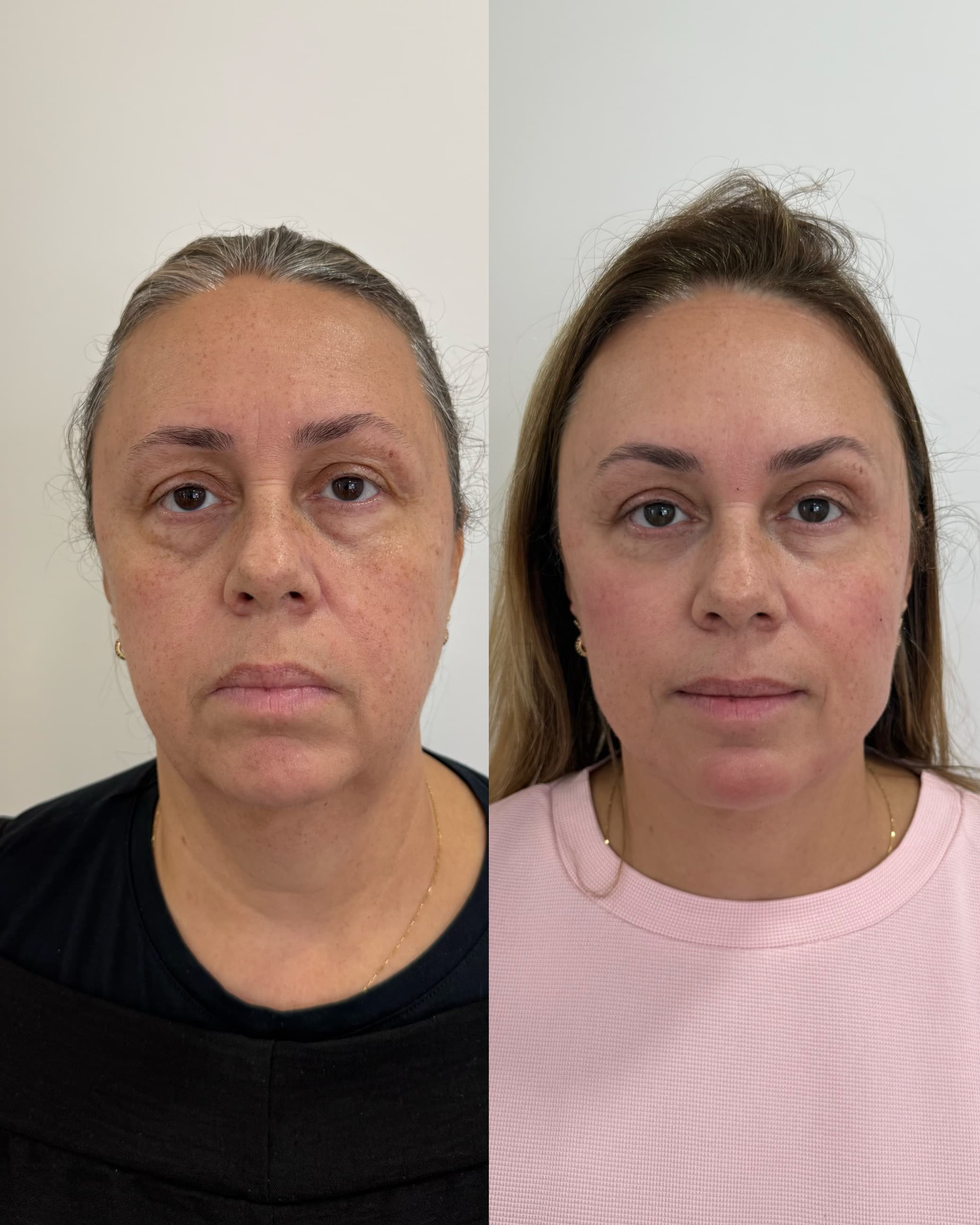 Antes e depois — Harmonização facial completa + emagrecimento