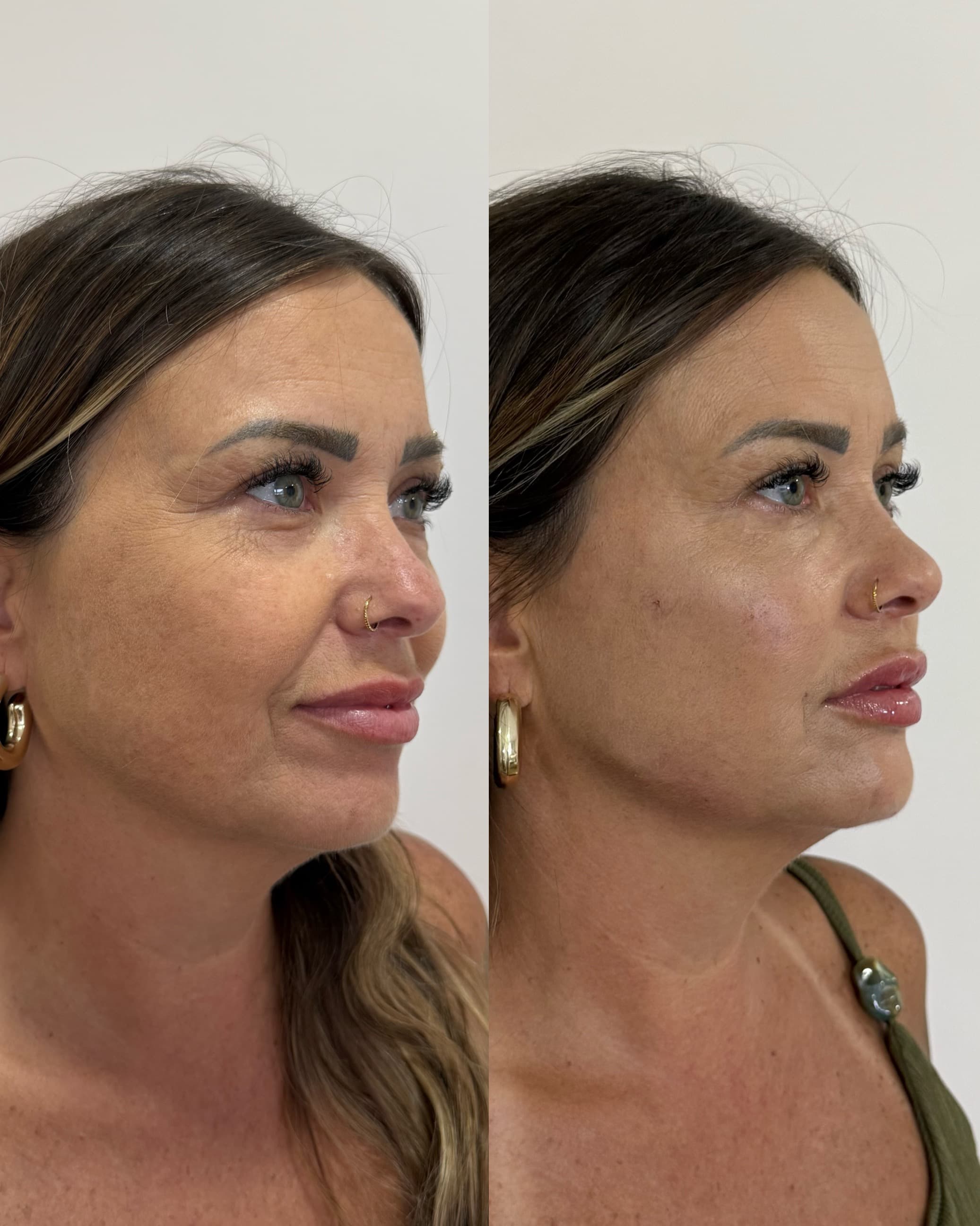 Antes e depois — Preenchimento labial + bioestimulador + PRF