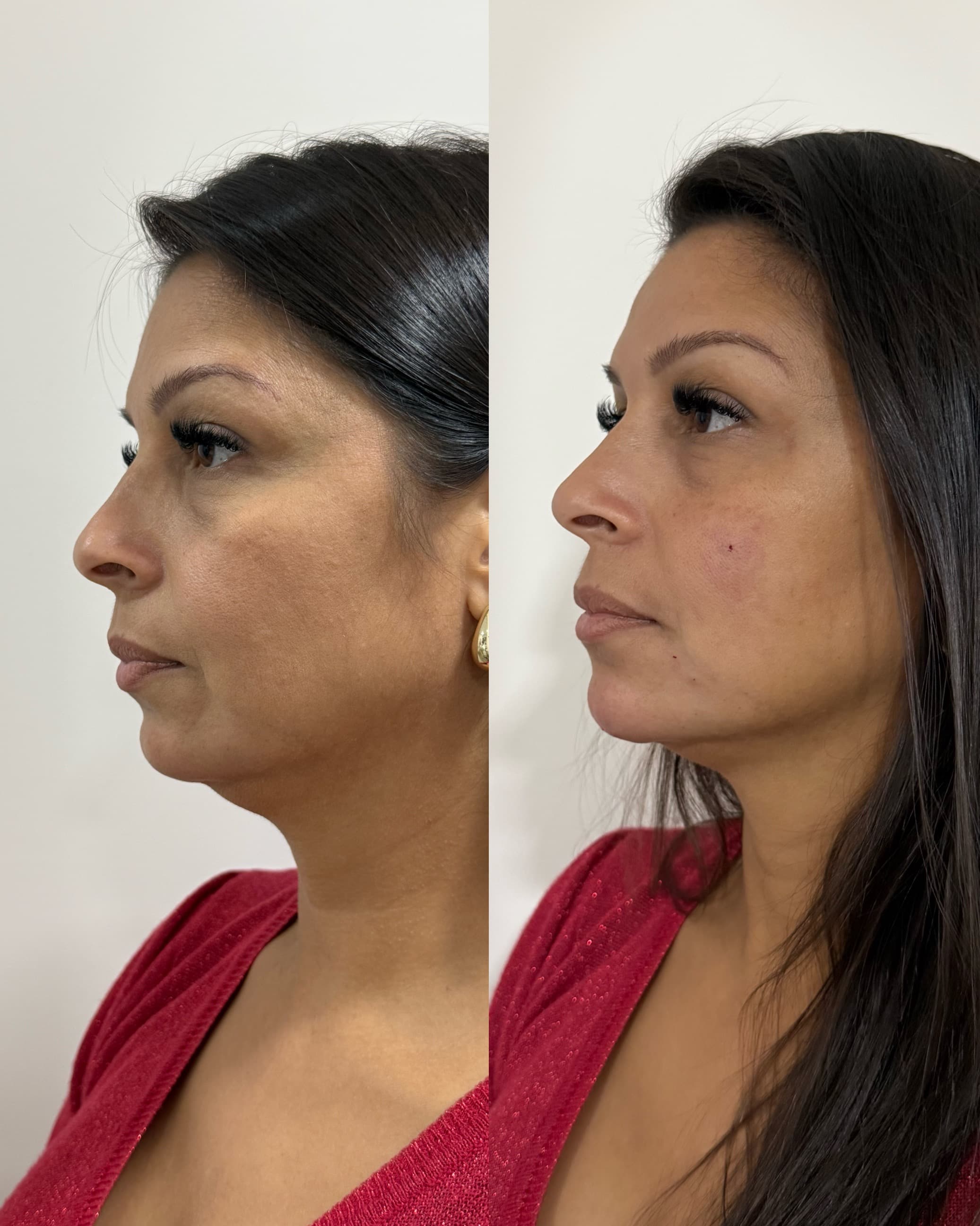 Antes e depois — Preenchimento de mento + linha da marionete + olheiras