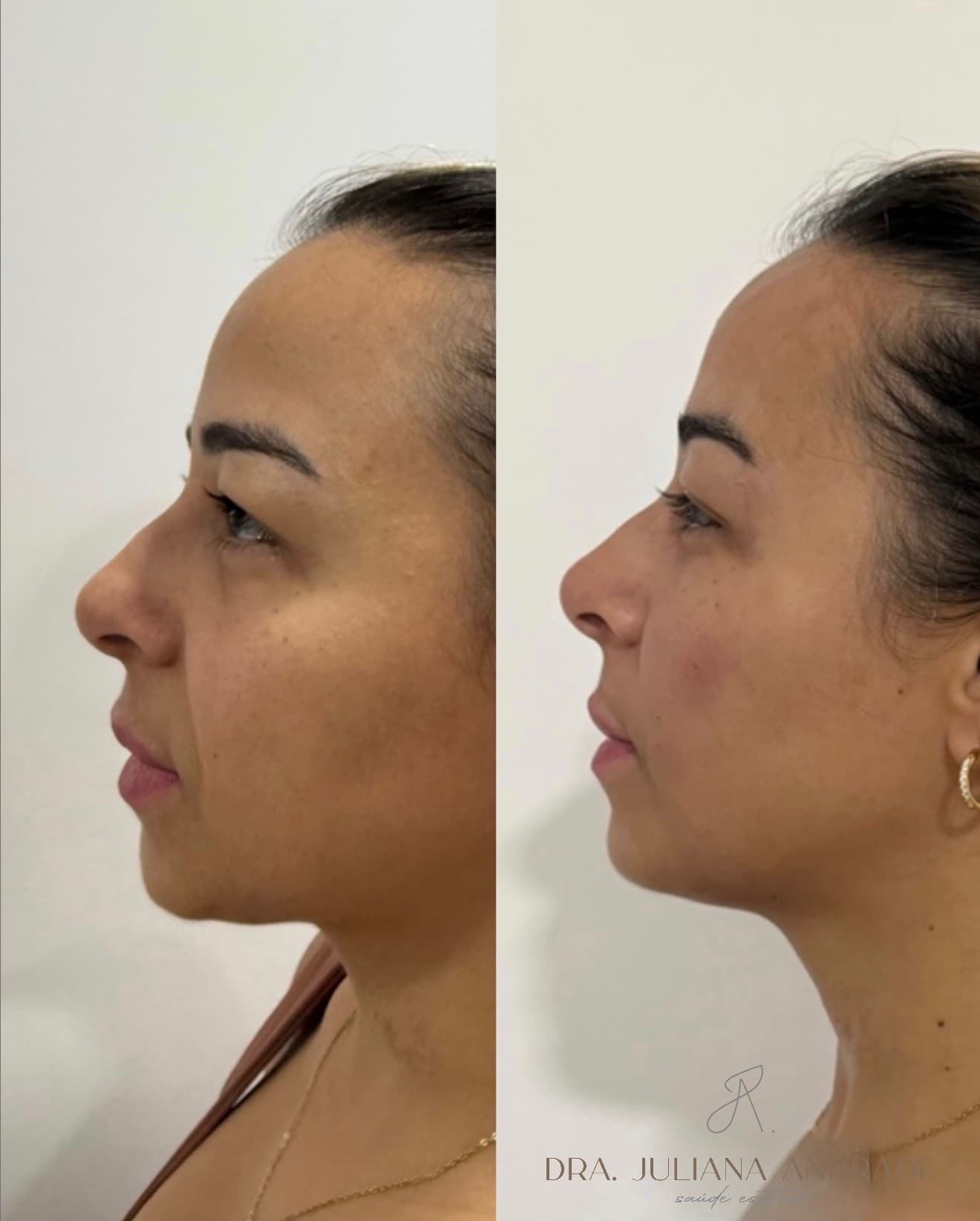 Antes e depois — Rinomodelação + harmonização do terço inferior